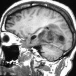 ‘Encouraging’ Early Data for mRNA Vaccine in Glioblastoma