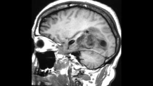 ‘Encouraging’ Early Data for mRNA Vaccine in Glioblastoma