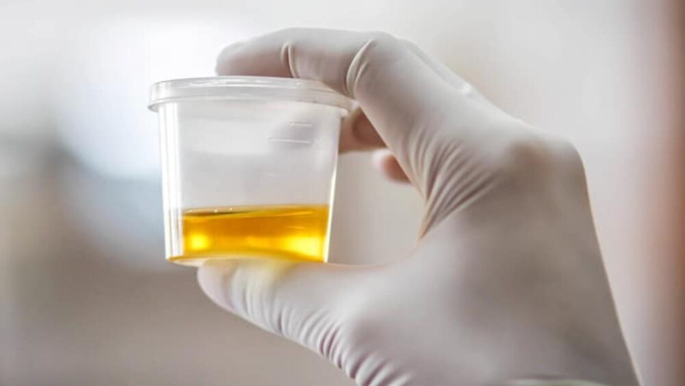 24-Hour Urine Testing in Multiple Myeloma: Time to Stop?